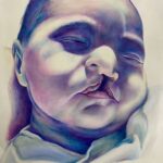 Cleft Lip and Palate